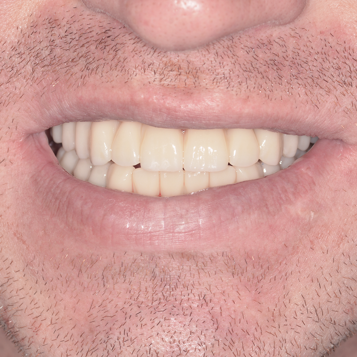 Gunčio šypsena po ALL-ON-4 procedūros