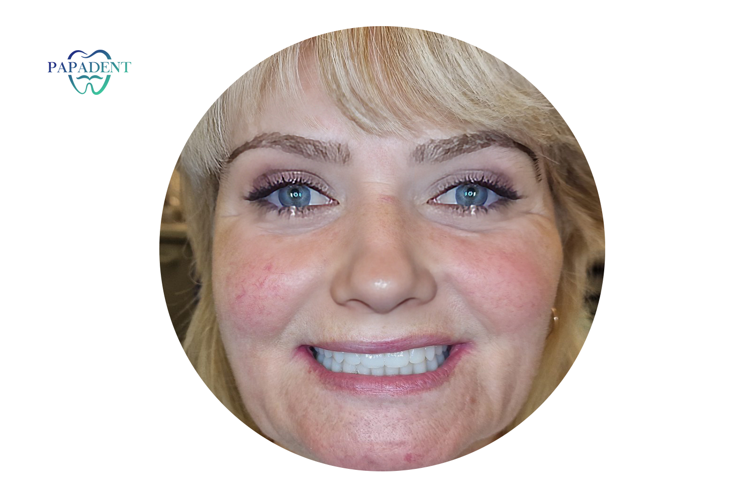 Sofia unterzog sich einer All-on-4-Implantation