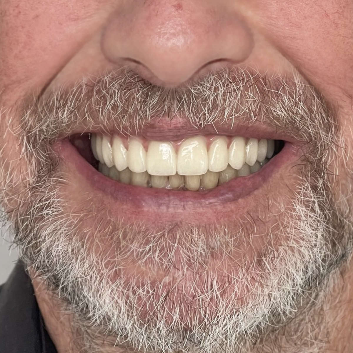 Vollständige Kieferimplantation für Dainis