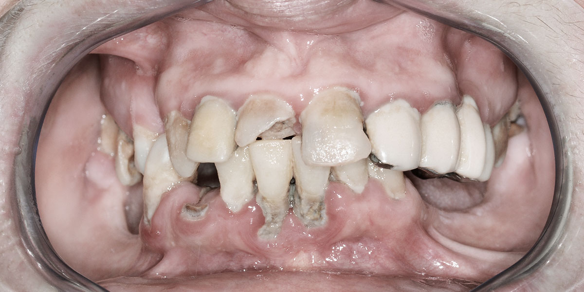 Vorher - Gintarė - 11 Zähne im Ober- und 8 Zähne im Unterkiefer entfernt