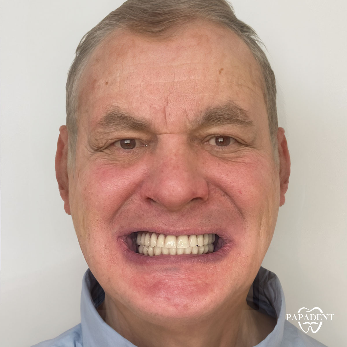 Petras - Alle Zähne auf vier Implantaten